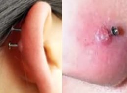 DRENAR GRANULOMA